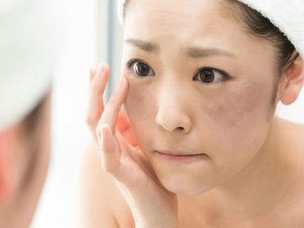 [Review] 5 cách trị nám đơn giản tại nhà với những nguyên liệu dễ tìm