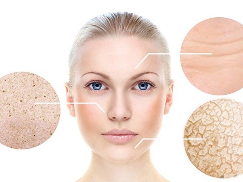 [Review] Mách chị em cách trị nám da mặt hiệu quả tận gốc