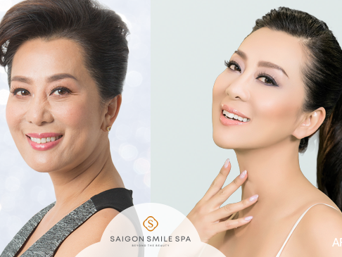 [Review] Hội chị em rủ nhau hồi xuân với phương pháp trẻ hoá bằng công nghệ Thermage