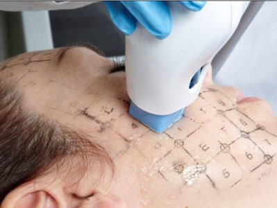 Phương pháp trẻ hóa bằng Thermage – cứu tinh cho làn da lão hóa