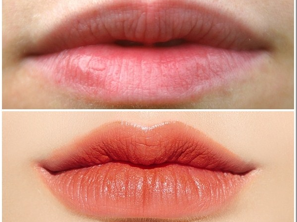 [Review] Nên tiêm filler môi trái tim hay cắt môi trái tim?