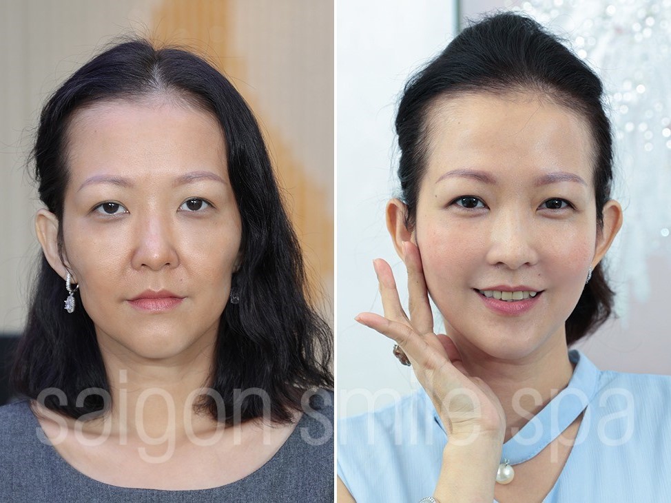 [Review] Xu hướng làm đầy thái dương bằng công nghệ Beauty Blossom được hội chị em ưa thích gần đây.