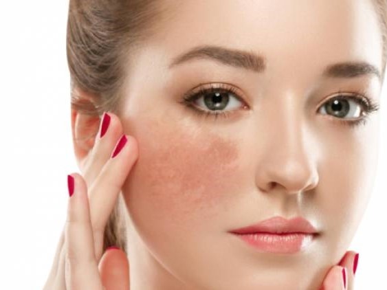 Giúp chị em trả lời câu hỏi: Trị nám nhanh dùng phương pháp nào?