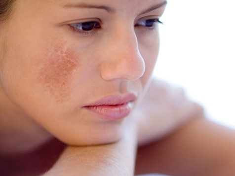 [REVIEW] Đánh bay vết nám gây tự ti, mẹ bỉm chia sẻ spa trị nám tại Sài Gòn uy tín