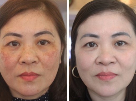[REVIEW] HÀNH TRÌNH TRỊ NÁM CHO MẸ U50