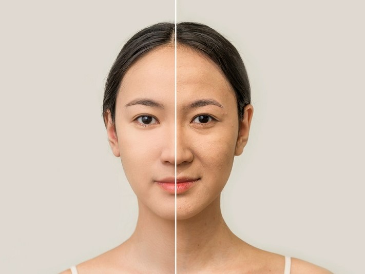 Dù đã ngoài 30 nhưng gương mặt nữ khách hàng 9x vẫn tươi trẻ nhờ nâng cơ mặt
