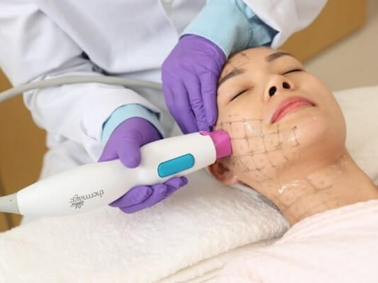 Nữ khách hàng U50 bất ngờ “trẻ hóa” nhờ công nghệ Thermage