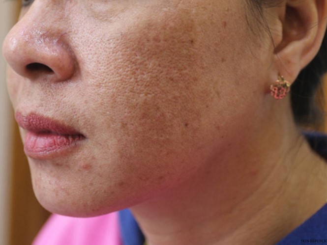 Câu chuyện trị nám thành công không hề tái phát
