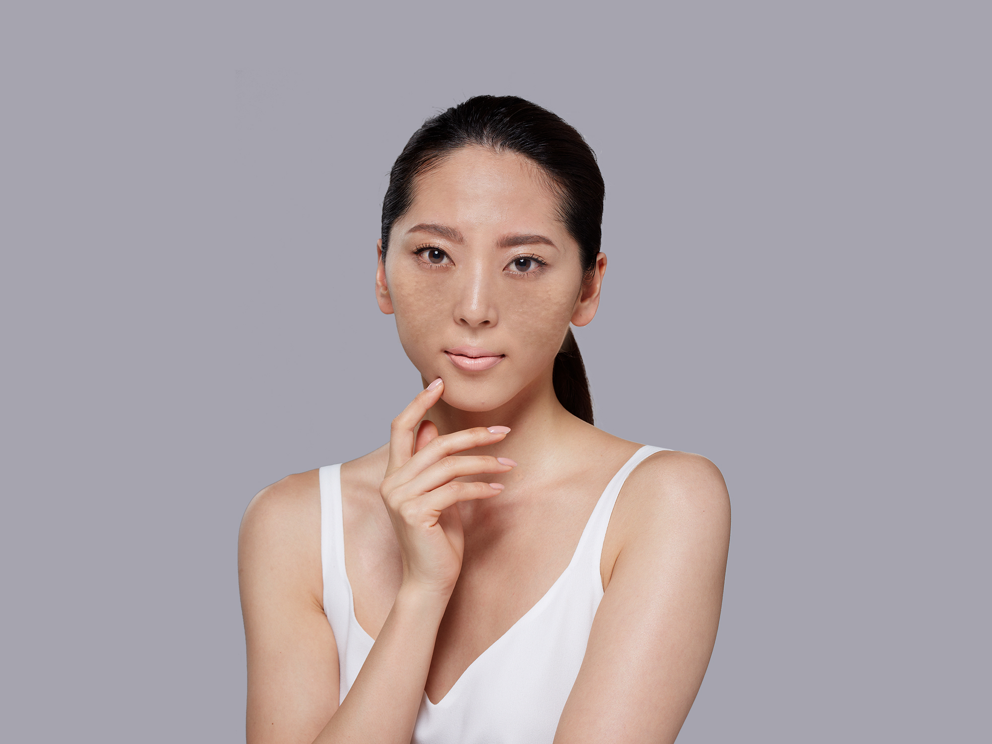 Suýt trả giá đắt vì chữa nám sai cách