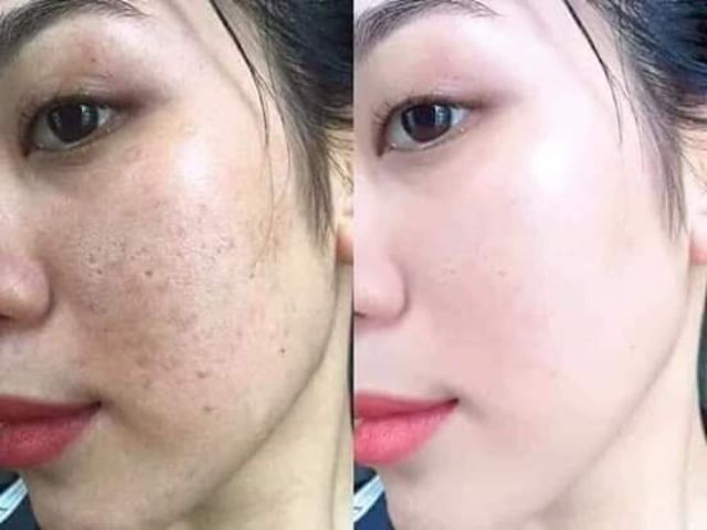 Trị thâm nám triệt để giúp chị em tự tin khoe sắc