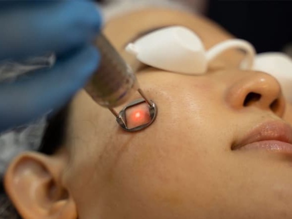 Bắn laser trị tàn nhang – xu thế làm đẹp mới có thực sự hiệu quả?