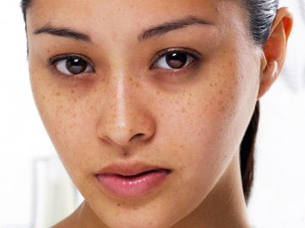 Saigon Smile Spa giải đáp thắc mắc tại sao bị tàn nhang cho hàng triệu chị em phụ nữ