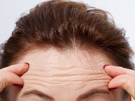 Biến hình cho nữ doanh nhân chỉ sau 60 phút xóa nếp nhăn trán