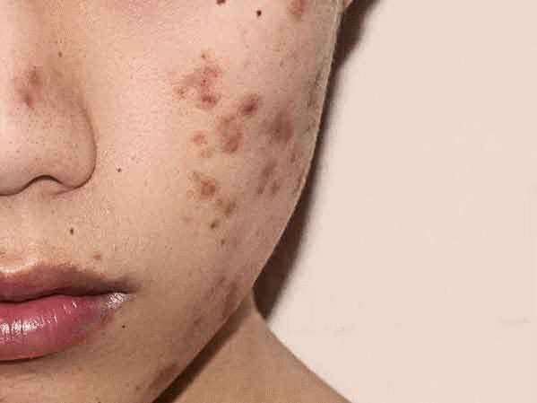 Những nguyên nhân bị tàn nhang có thể chị em chưa biết