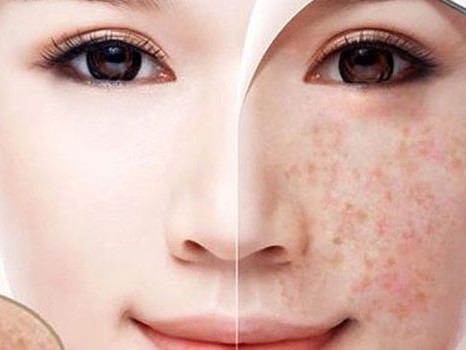 [REVIEW] Mẹ bỉm sữa trị nám tàn nhang thành công sau 5 năm dai dẳng