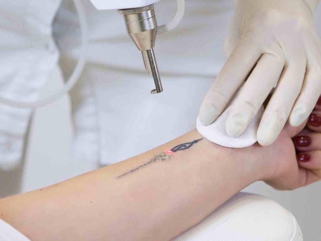 Xóa xăm bằng Laser hiệu quả, an toàn trong “1 nốt nhạc”
