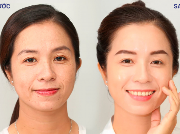 Tự ti vì già hơn bạn bè đồng trang lứa, chủ shop “ráo riết” tìm cách giảm nếp nhăn
