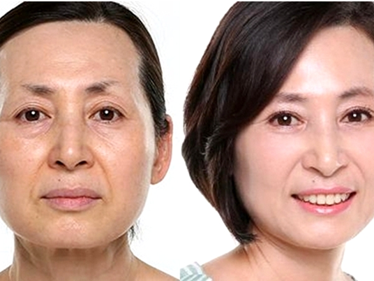 Công nghệ trẻ hóa da Ultherapy giúp mẹ đơn thân U50 thay đổi diện mạo