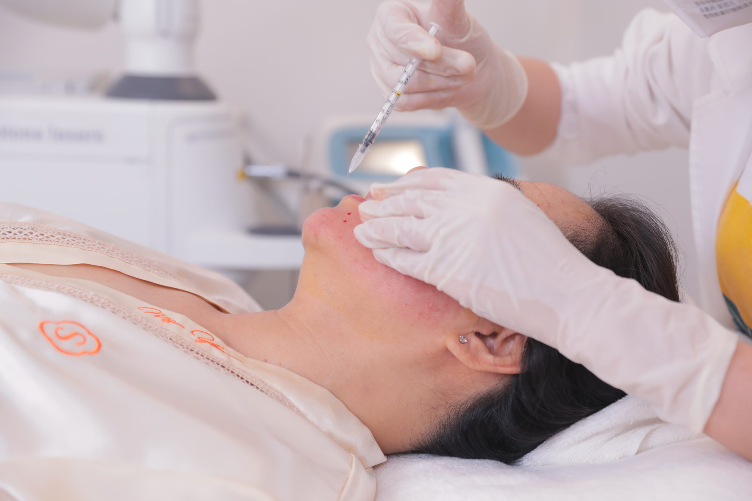 bắp véo thuốc đuôi mắt tiền