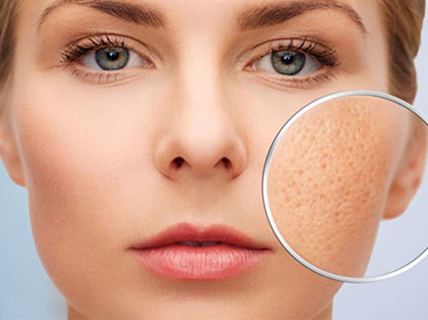 Lột xác thành hoa khôi Đại học nhờ điều trị mụn dứt điểm