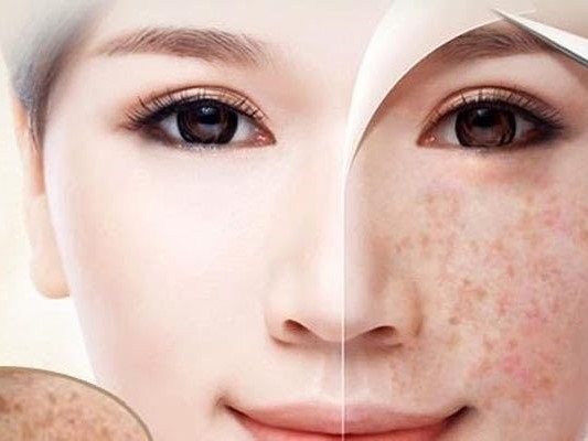 Lấy lại tự tin, thăng hạng nhan sắc khi không còn tàn nhang