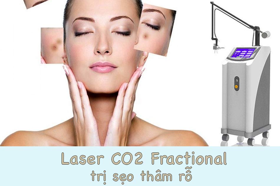 toning gì carbon tinh webtretho