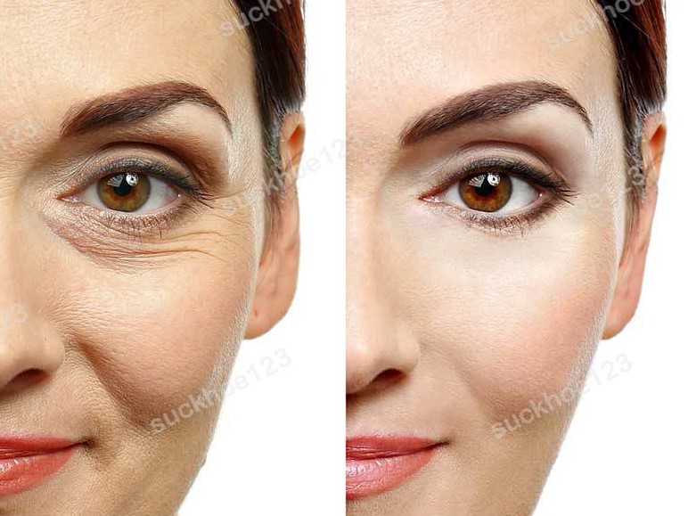 Nữ trưởng phòng lấy lại thanh xuân với công nghệ trẻ hóa duy nhất tại Saigon Smile Spa