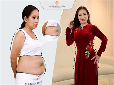 Cách giảm mỡ bụng hiệu quả nhất hiện nay