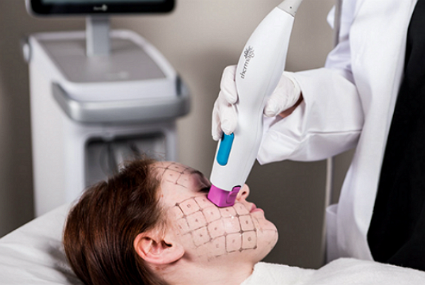Công nghệ Thermage FLX – Phương pháp làm đẹp không phẫu thuật cho làn da săn chắc, mịn màng