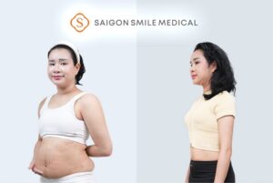 Chỉ 48 ngày trước Tết: Hot TikToker tiêu thố giảm 13kg, thu gọn 23cm vòng bụng nhờ AI Slimtech