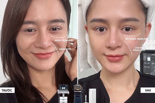 Rãnh cười đầy hơn – Nhăn mắt mờ dần – Bọng mắt cải thiện rõ