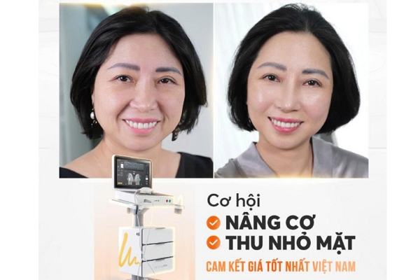 Xu hướng làm đẹp Tết 2026: Nâng cơ, thu gọn gương mặt với Ultherapy Prime