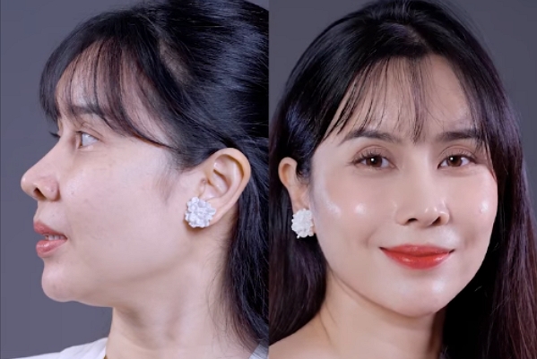 “Xóa sổ” nọng cằm – Lấy lại góc nghiêng thanh thoát