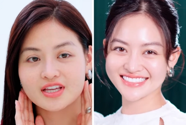 Thùy Anh công khai cận cảnh “gọt hàm” không dao kéo bằng Ultheapy Prime