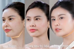 Góc nghiêng “đổ nát” vì nọng cằm? Bí quyết hủy sạch chỉ sau 60 phút