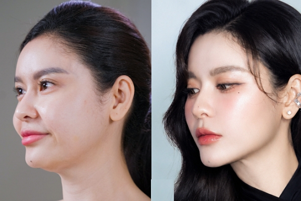 Review xóa nọng cằm tại Saigon Smile – Góc nghiêng gọn hơn sau 2 tuần