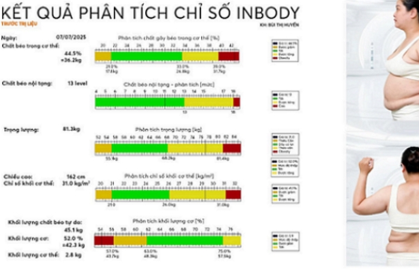 Chỉ số mỡ cơ thể cao – Dấu hiệu cảnh báo sức khỏe cần được quan tâm