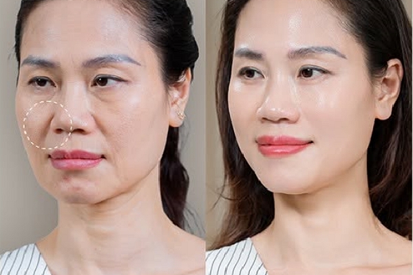 Ultherapy Prime chỉ từ 9 triệu: Tạm biệt rãnh cười sâu – Lấy lại gương mặt thanh xuân
