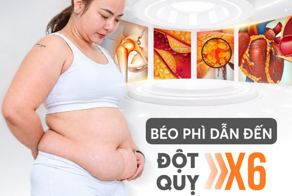 Béo phì – “cái bẫy” âm thầm làm gia tăng nguy cơ đột quỵ